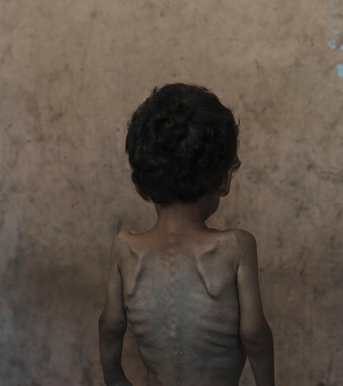 APTOPIX Mideast Wars Dying of Hunger