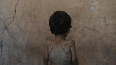 APTOPIX Mideast Wars Dying of Hunger