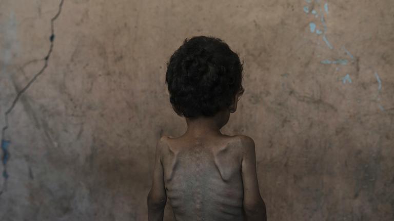 APTOPIX Mideast Wars Dying of Hunger