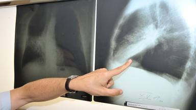 Ein Arzt zeigt auf ein Röntgenbild einer von Krebs befallenen Lunge.