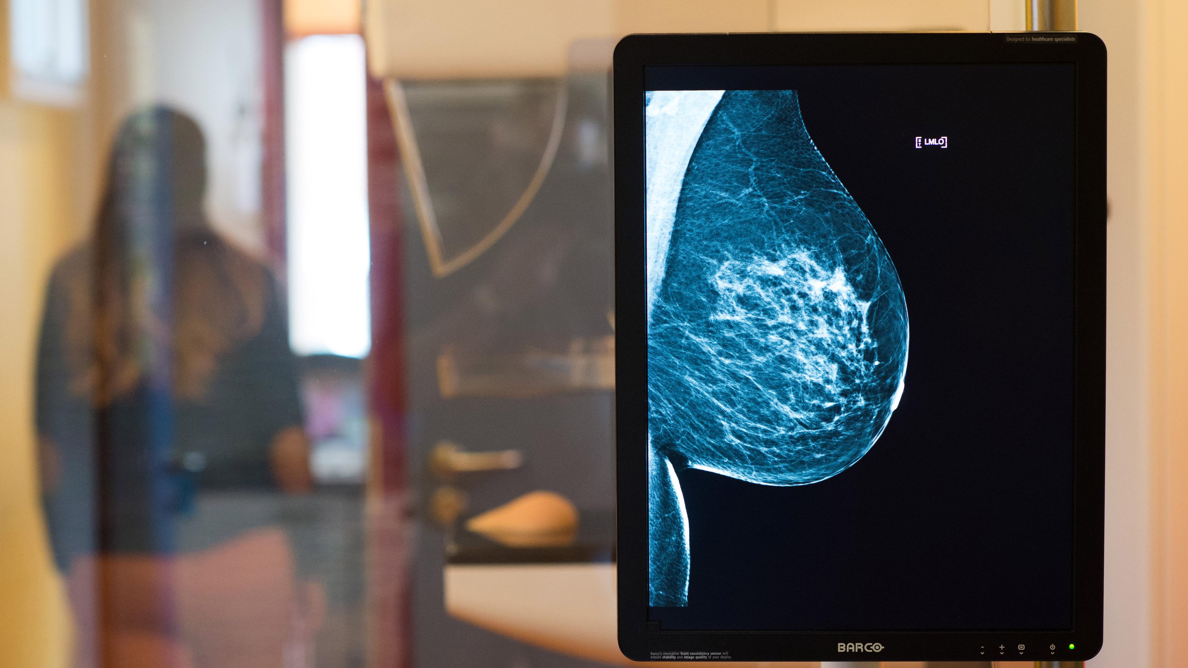 aufnahme eines mammographie-screenings
