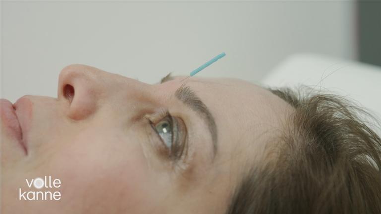 Akupunktur bei Migräne