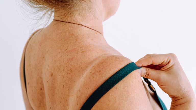 Ausschnitt des oberen Rückens einer Frau mittleren Alters mit Altersflecken