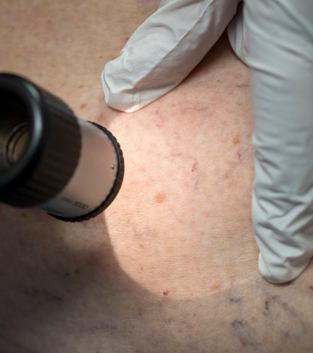 04.03.2025, Bayern, München: Ein Arzt untersucht in der Praxis die Hautpartie eines Patienten.