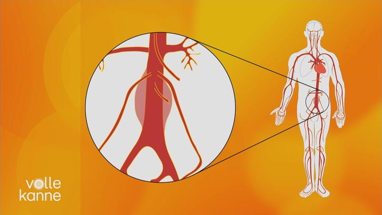 Lebensgefahr bei Aortenaneurysma 