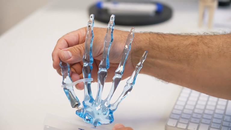 Daumensattelgelenk-Prothese in einem durchsichtigen Hand-Modell