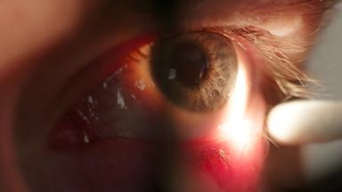Es ist ein Auge in Nahaufnahme mit einem entzündeten Lidrand zu sehen.