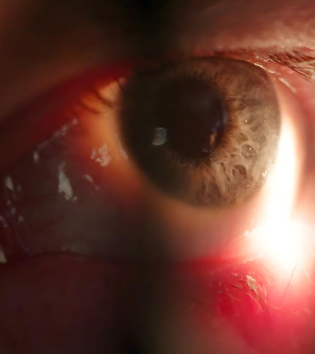 Es ist ein Auge in Nahaufnahme mit einem entzündeten Lidrand zu sehen.