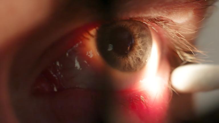 Es ist ein Auge in Nahaufnahme mit einem entzündeten Lidrand zu sehen.