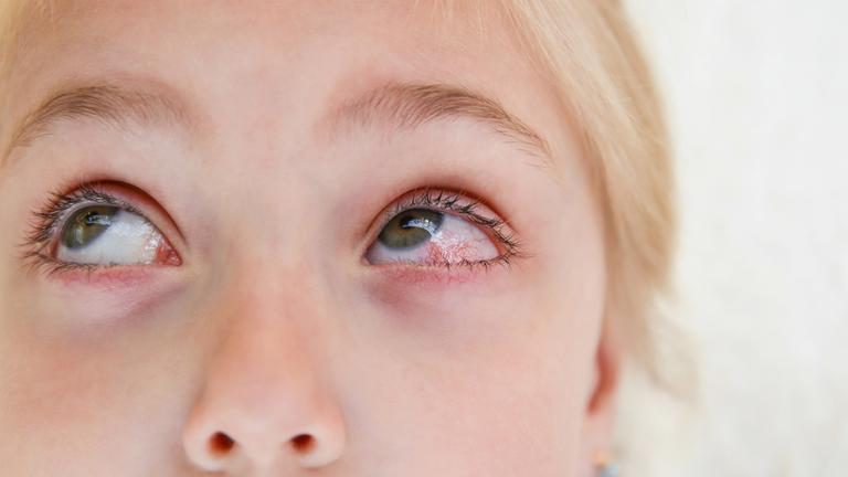 Ein Mädchens mit einer Bindehautentzündung schaut nach oben.