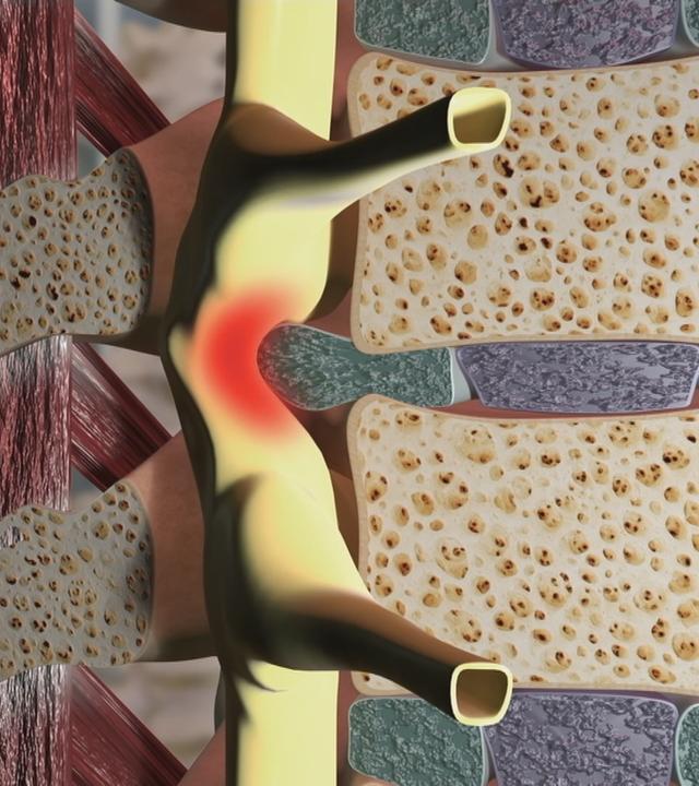 Grafik einer Wirbelsäule mit einem Bandscheibenvorfall