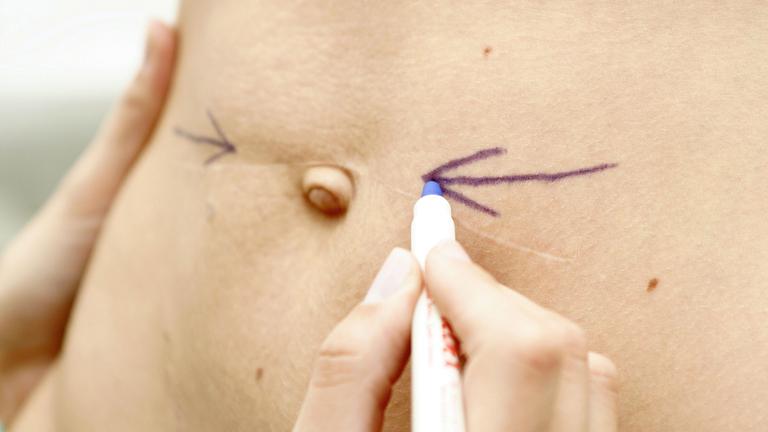 Ein nach außen gerichtetet Bauchnabel wird von einem Arzt mit Filzstift markiert.