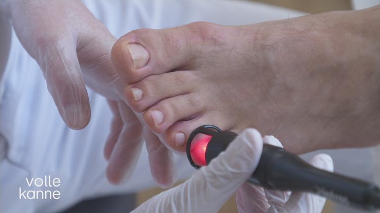 Neue Behandlung gegen Nagelpilz