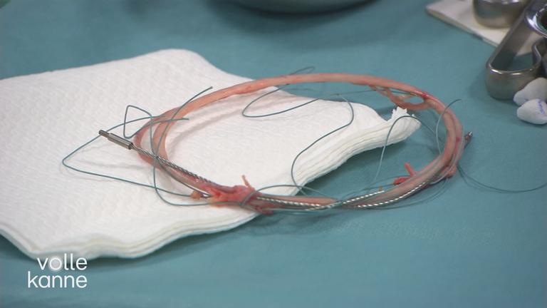 Behandlungsmöglichkeiten gegen Krampfadern