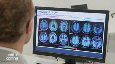 Schock am Welt-Alzheimer-Tag