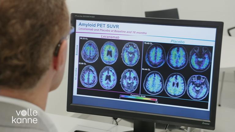 Schock am Welt-Alzheimer-Tag