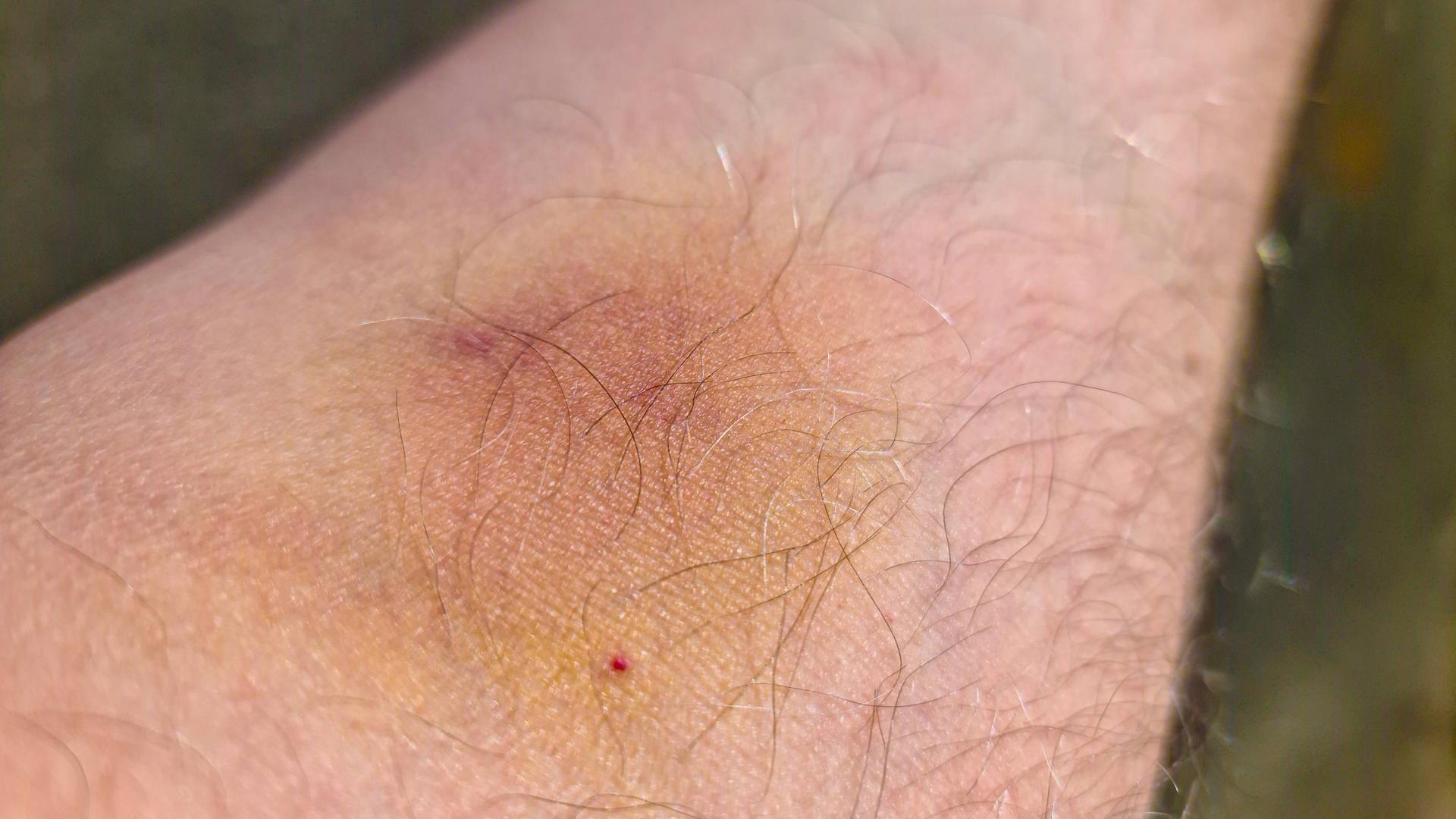 Blauer Fleck auf dem Arm eines Mannes