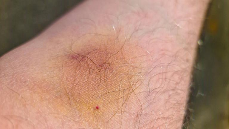 Blauer Fleck auf dem Arm eines Mannes