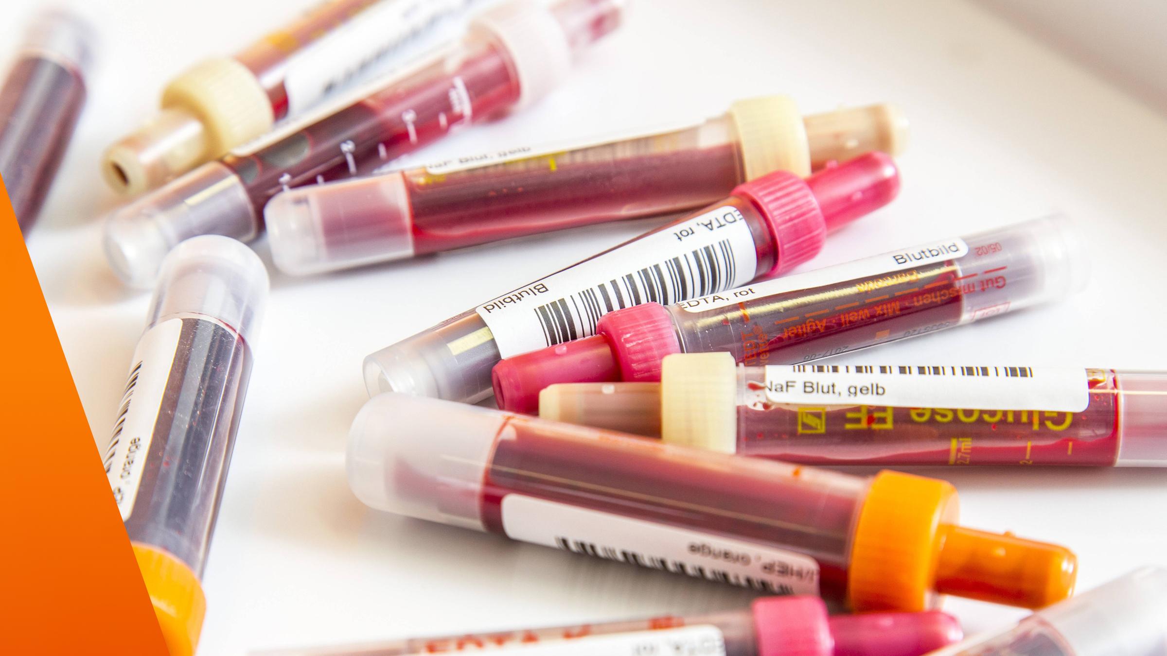 Mehrere unterschiedliche Spritzenampullen mit Blut für ein Blutbild