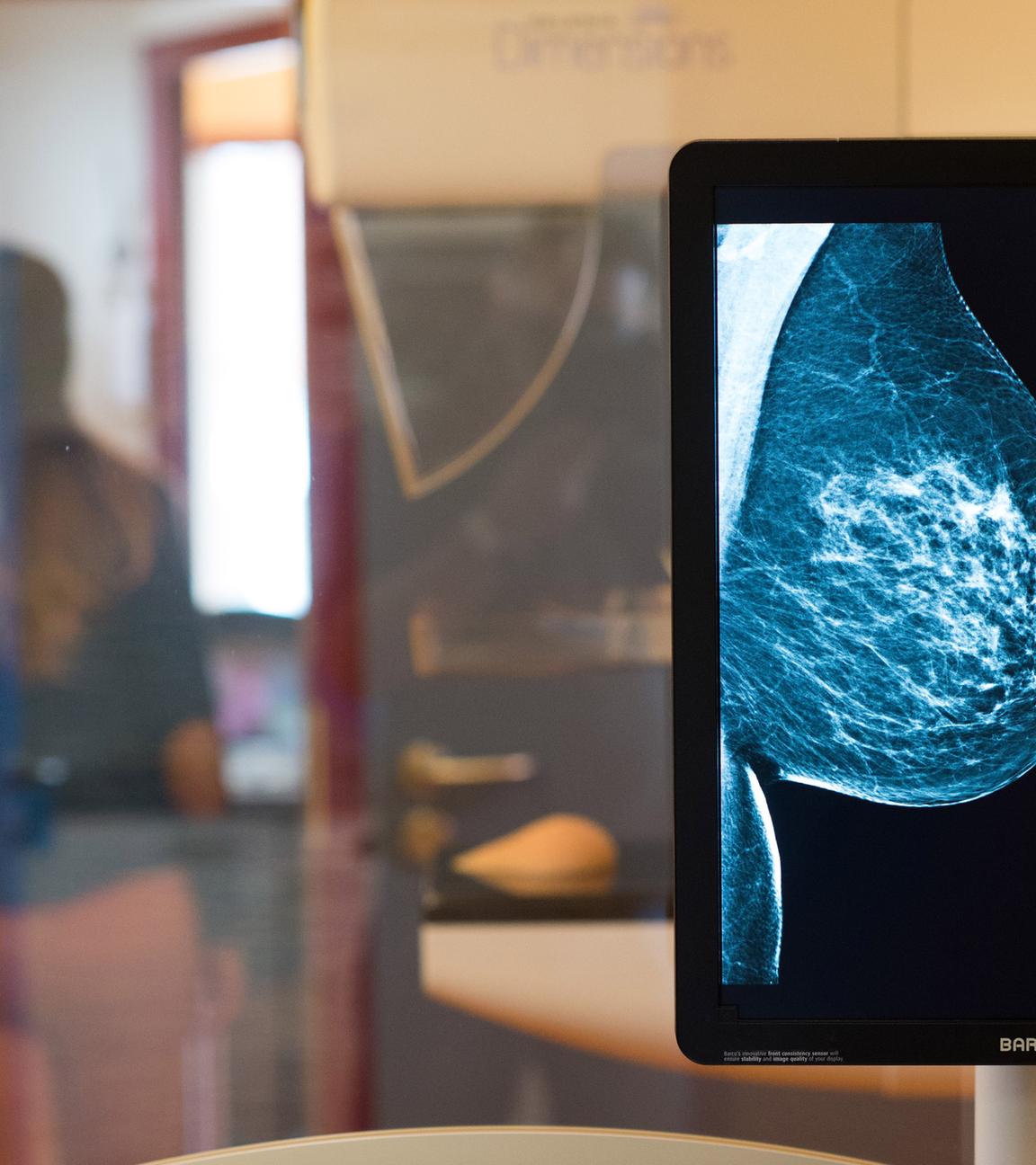 Die Aufnahmen eines Mammographie-Screenings im Vordergrund mit der durchleutchteten Brust.