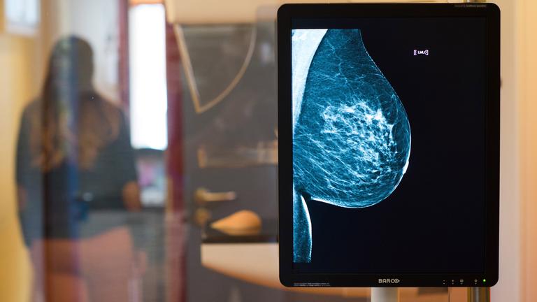 Die Aufnahmen eines Mammographie-Screenings im Vordergrund mit der durchleutchteten Brust.