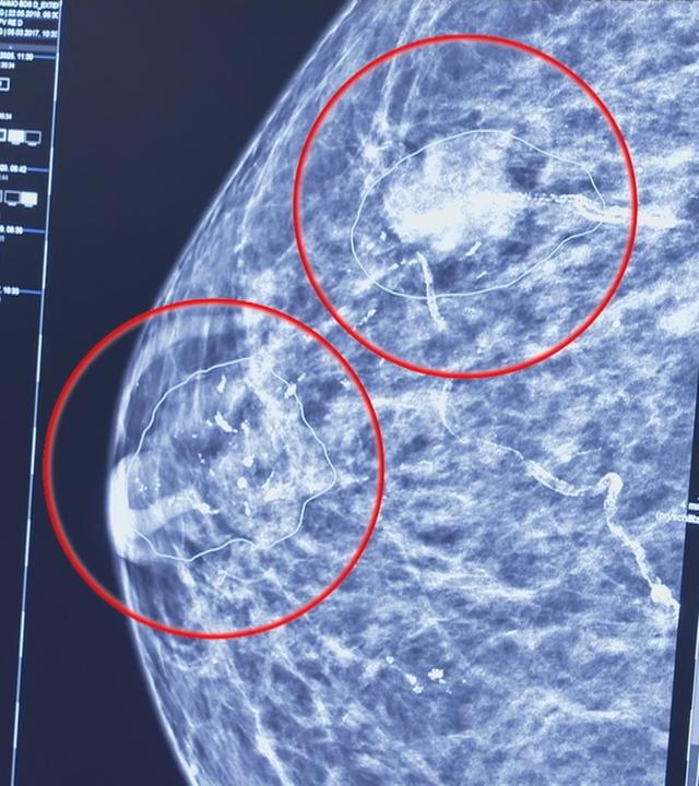 Auffälligkeiten in Bild von Brustgewebe
