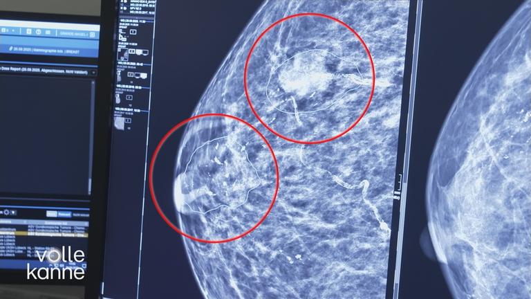 Auffälligkeiten in Bild von Brustgewebe