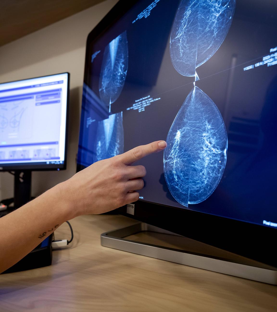 Eine Mammographie während einer Brustkrebsuntersuchung.