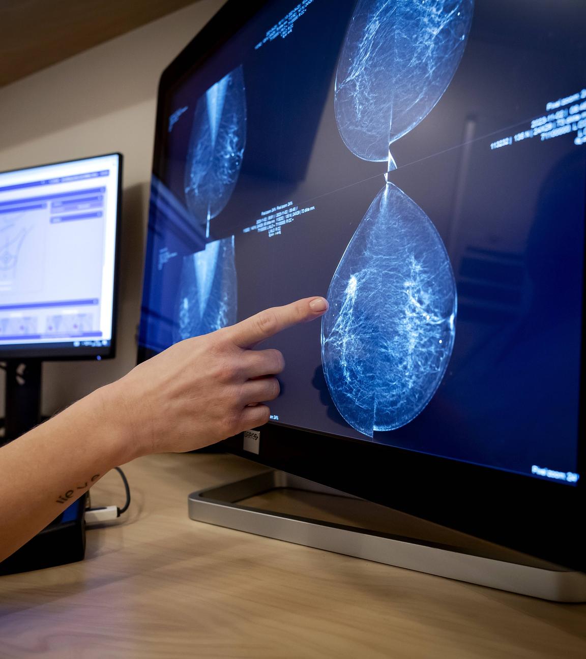Mammographer with screening employee during a breast cancer examination by an employee of Population Research Netherlands.