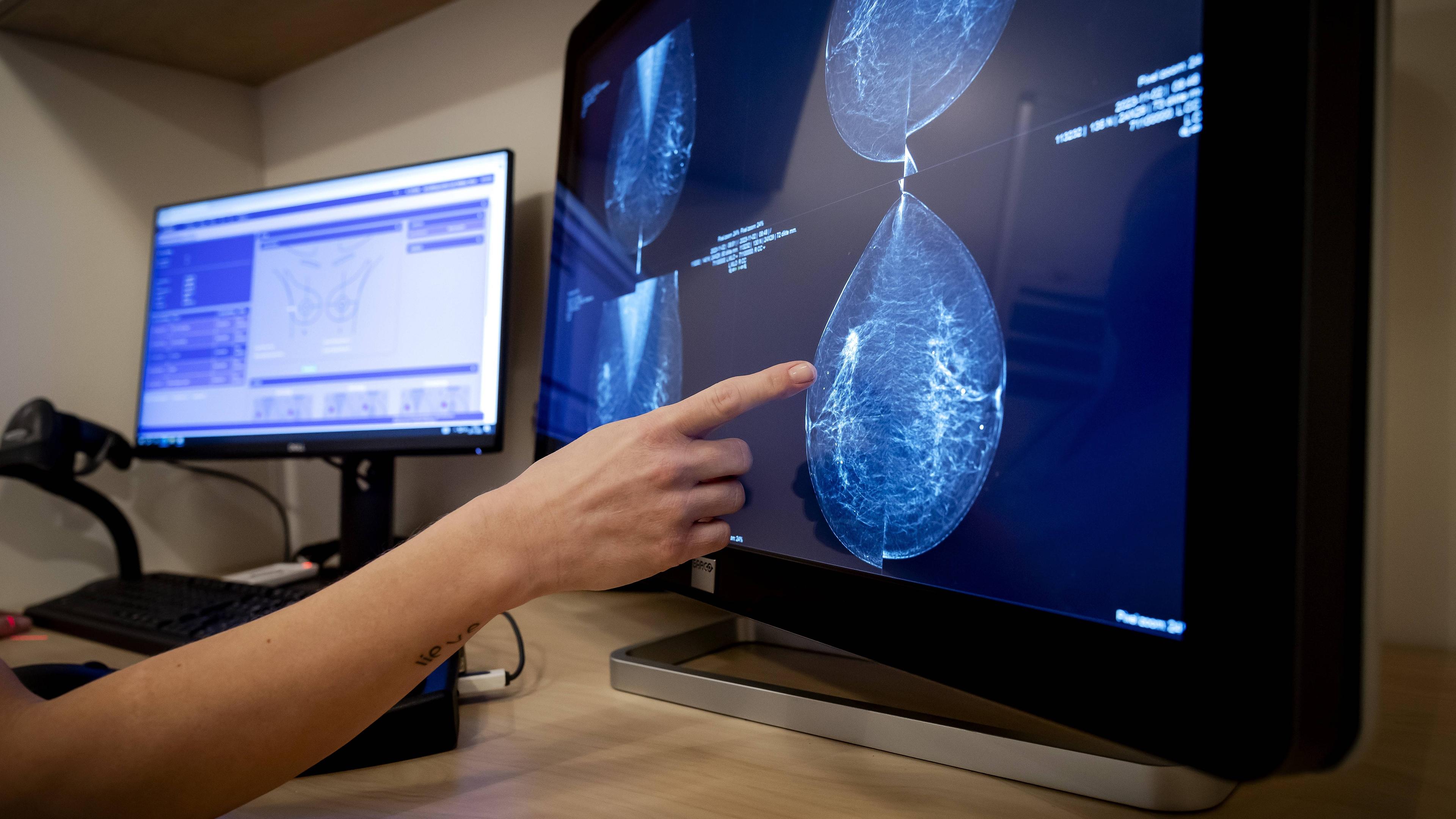 Mammographer with screening employee during a breast cancer examination by an employee of Population Research Netherlands.