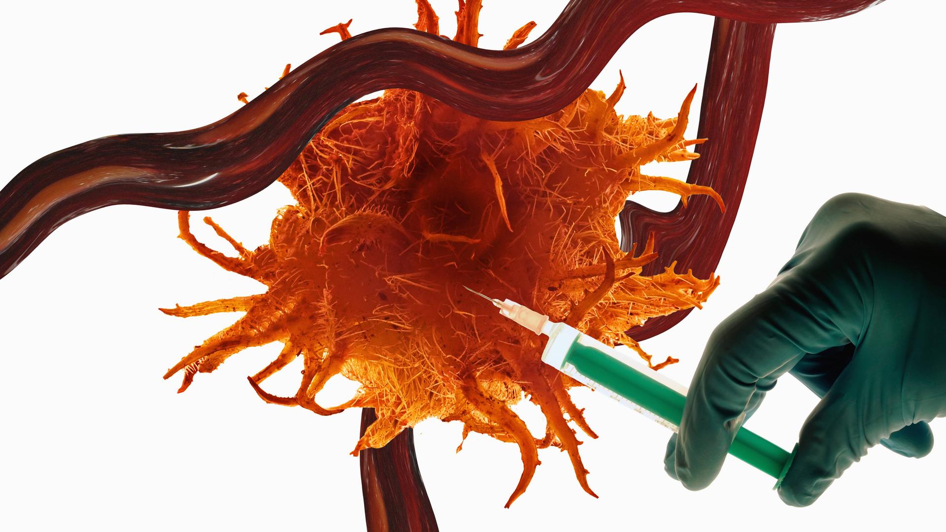 Therapie bei Brustkrebs