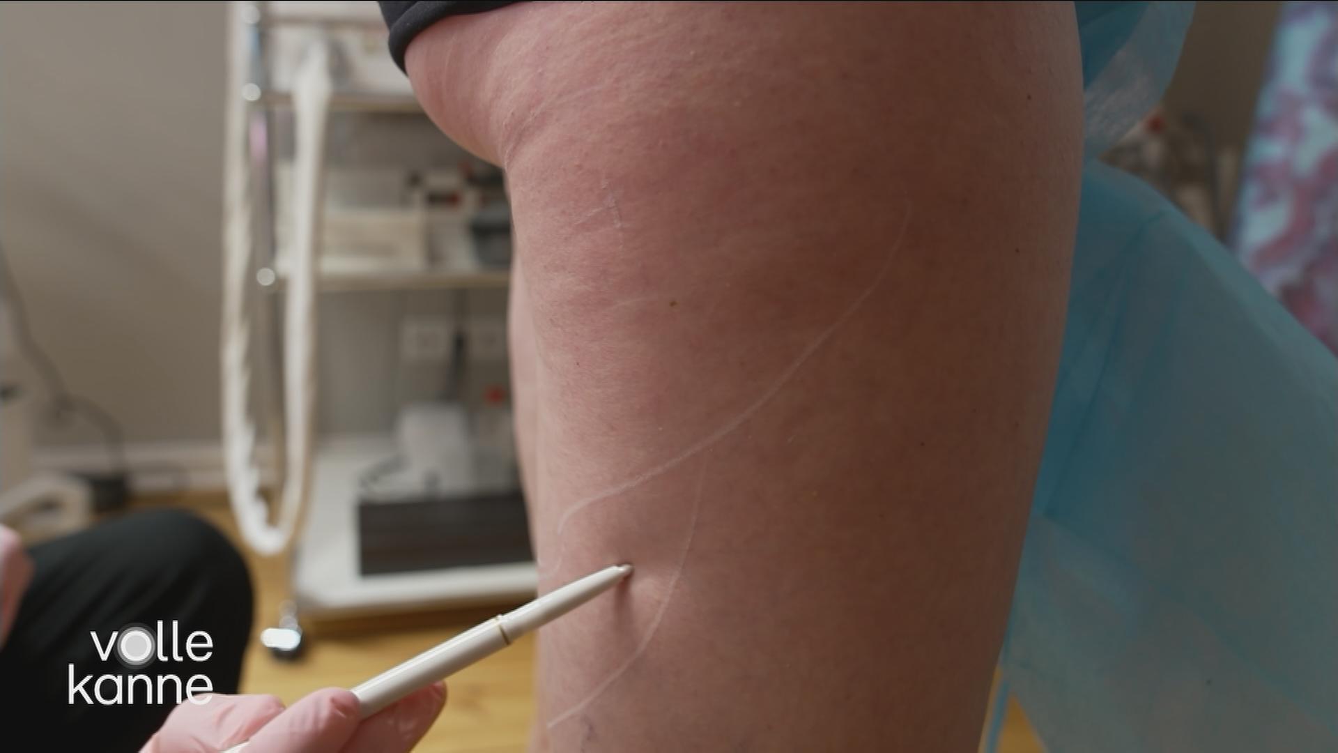 Cellulite