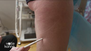 Cellulite