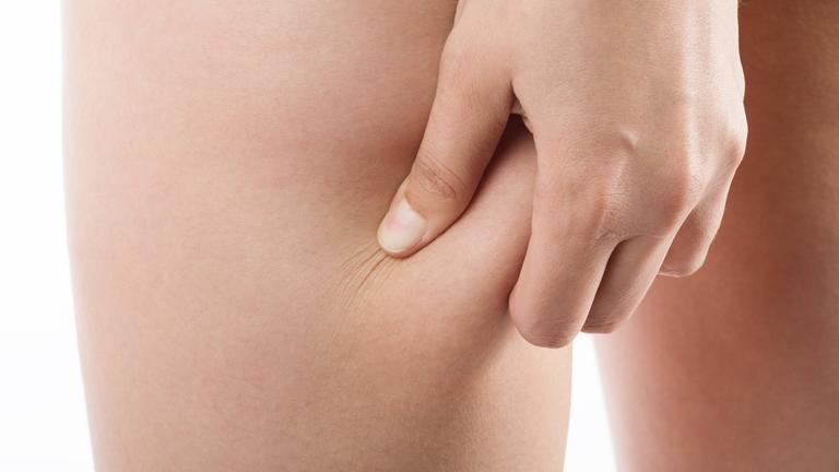 Frau fasst die Haut an ihrem Oerschenkel an.
