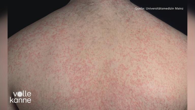 Ausschlag auf dem Rücken eines Mannes