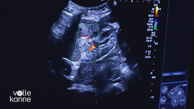 Chronische Nierenerkrankung