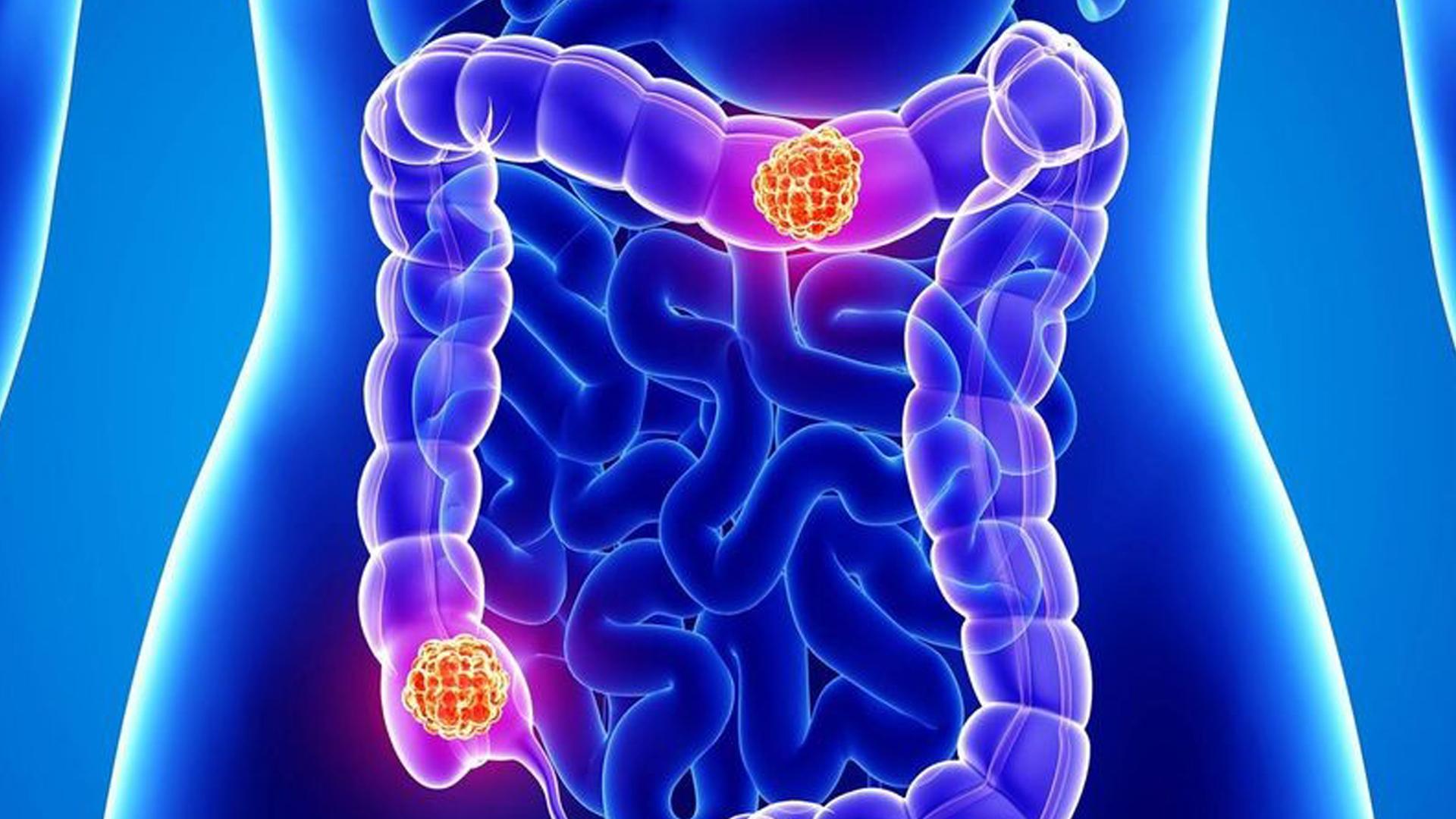 Computergrafik Darmkrebs