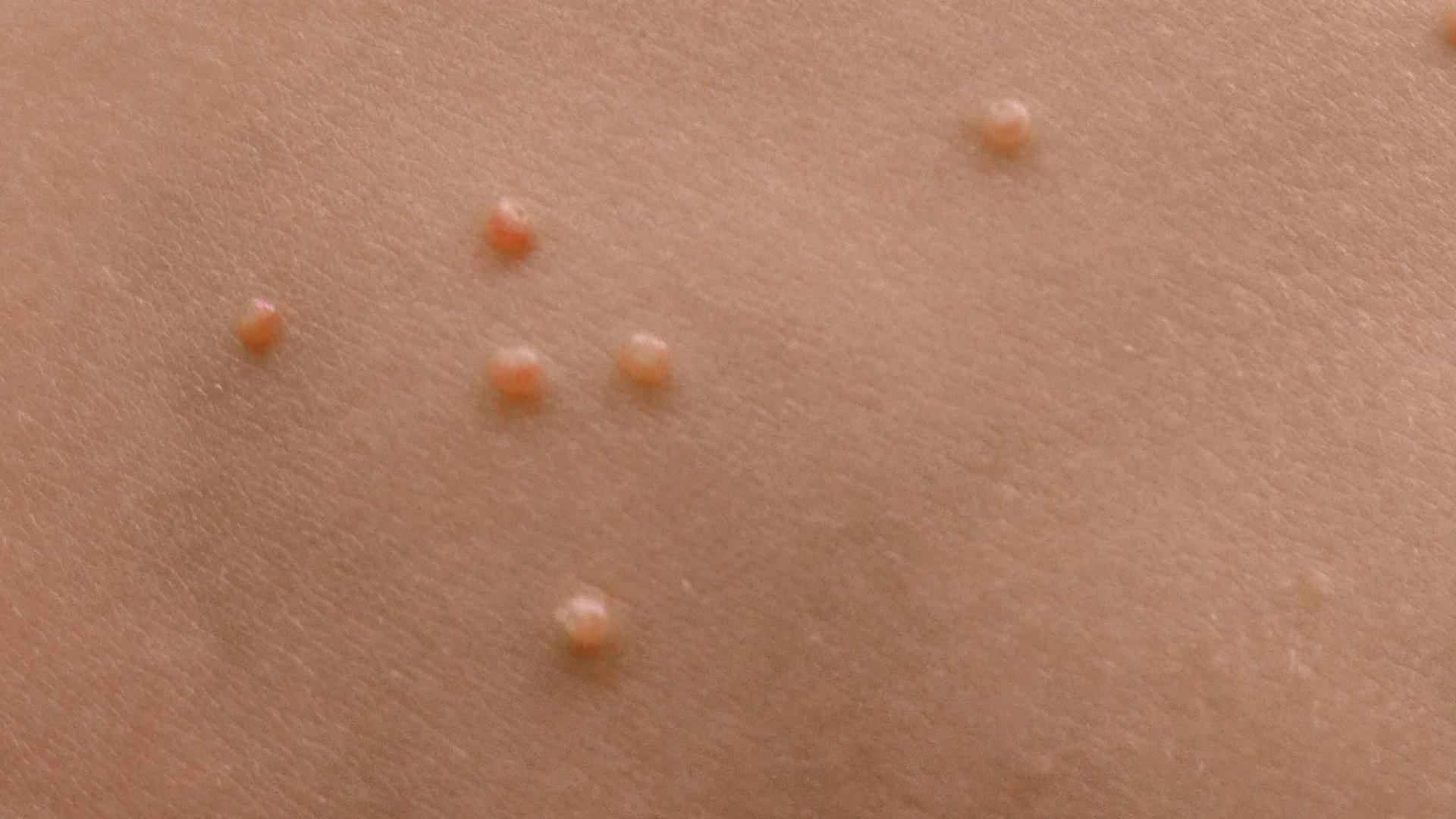 Dellwarzen auf einem Kinderbauch