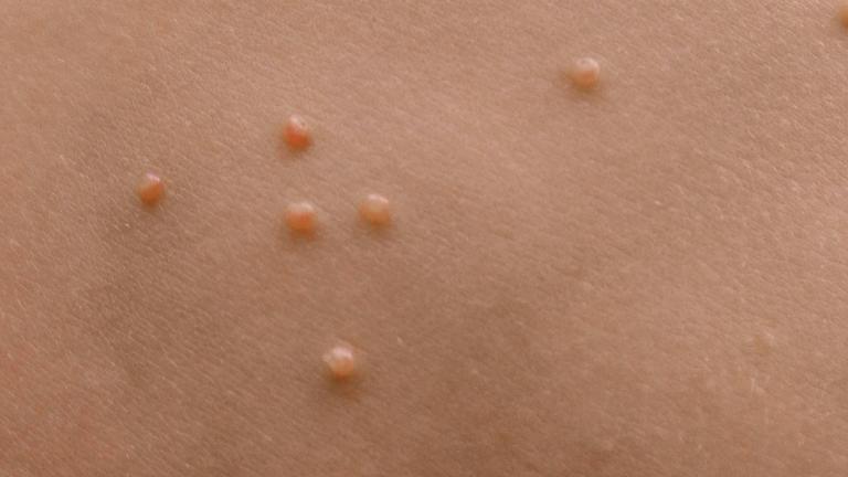 Dellwarzen auf einem Kinderbauch