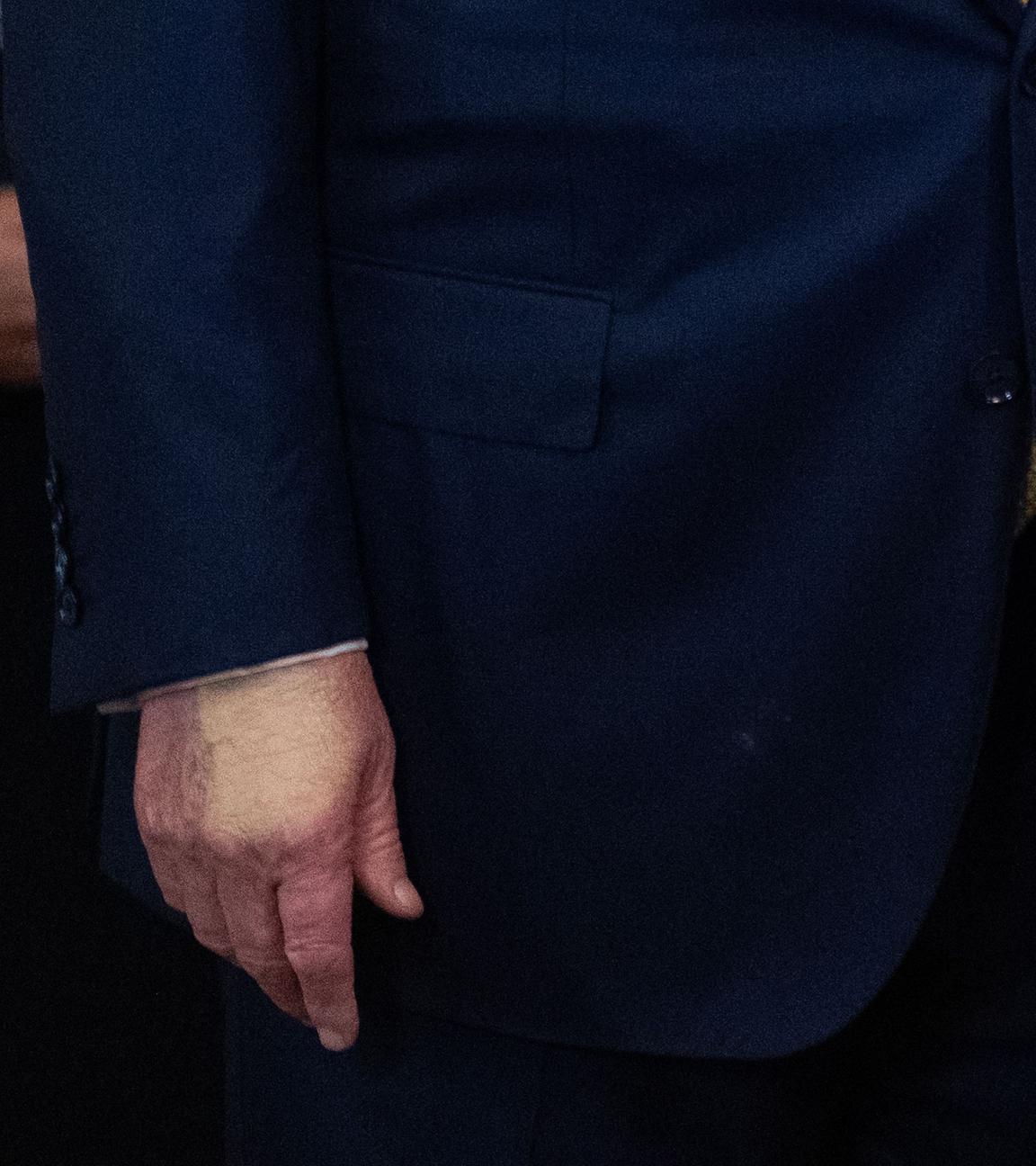 Eine Verfärbung ist auf der Hand von US-Präsident Donald Trump zu sehen