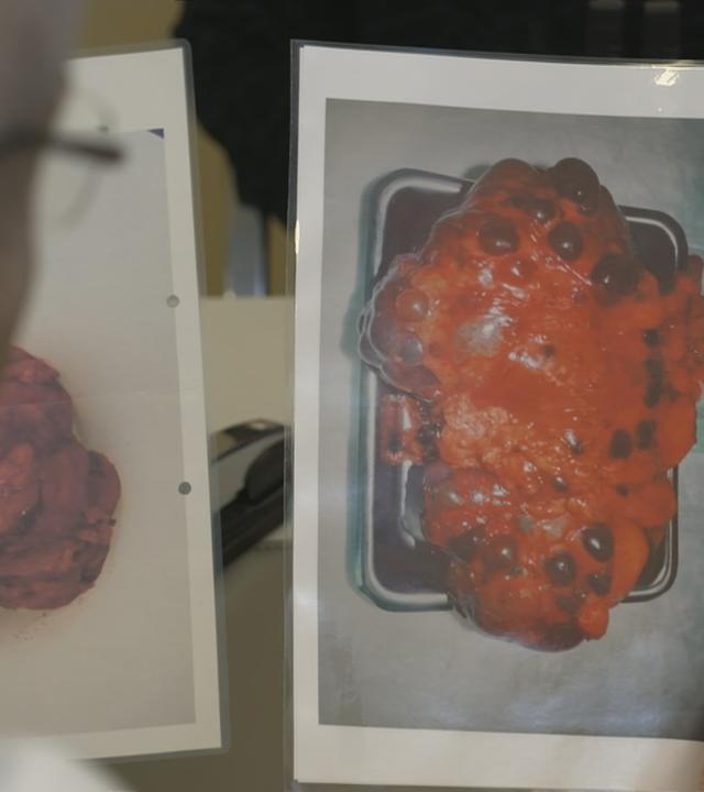 Ein Arzt schaut sich Bilder einer kranken Niere an.