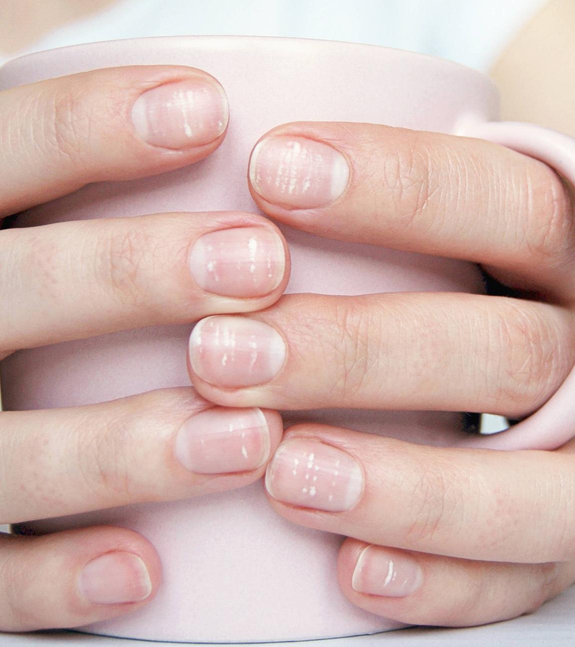 Hände umschließen eine Kaffeetasse. Auf den Fingernägeln sind weiße Flecken zu sehen.