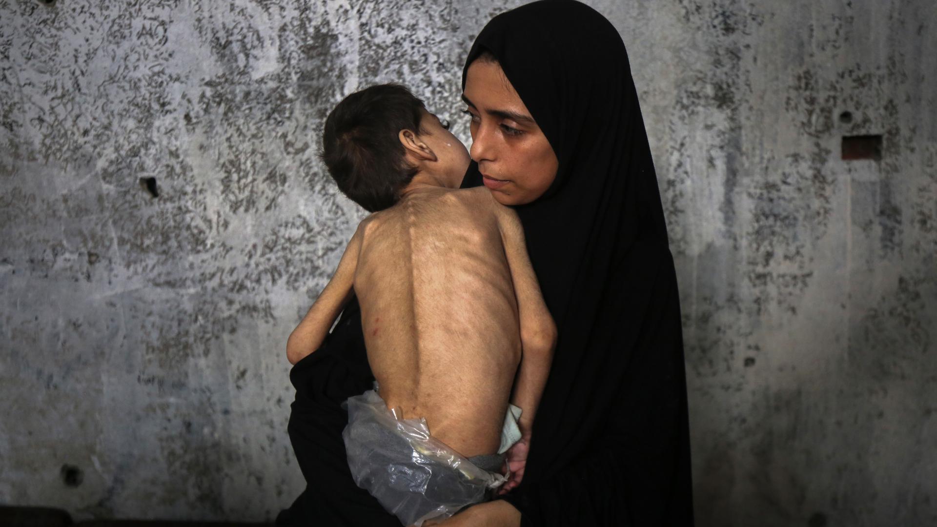 Palästinensische Gebiete, Gaza: Ein vertriebenes palästinensisches Kind, das an Unterernährung und zerebraler Lähmung leidet, am 25. Juli 2025 in einer zur Schule umfunktionierten Unterkunft im Nordwesten von Gaza-Stadt.