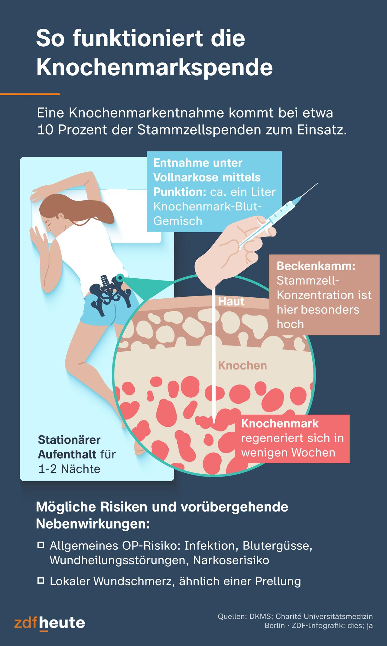 Grafik: Für eine Knochenmarkspende wird unter Vollnarkose ein Knochenmark-Blut-Gemisch entnommen