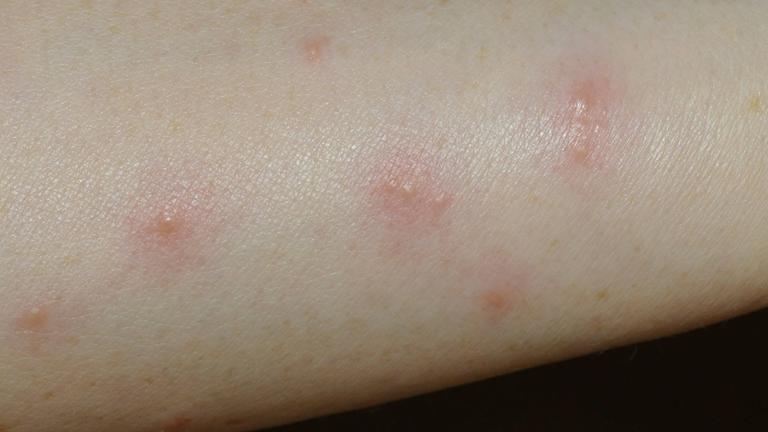 Pusteln auf Unterarm durch Bisse der Grasmilbe