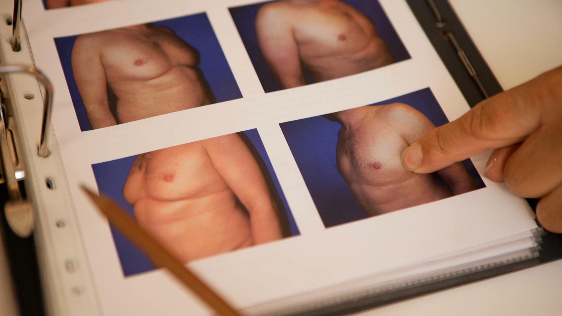 Auf einem Foto in einem Arztordner sind mehrere Fotos von Männern mit einer vergrößerten Brustdrüse zu sehen.