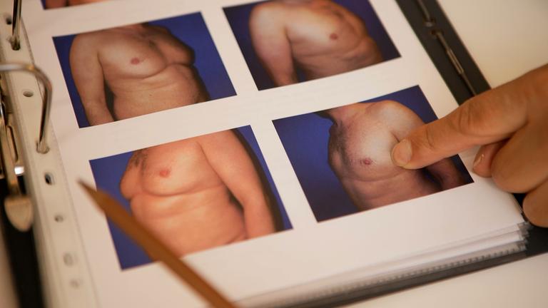 Auf einem Foto in einem Arztordner sind mehrere Fotos von Männern mit einer vergrößerten Brustdrüse zu sehen.