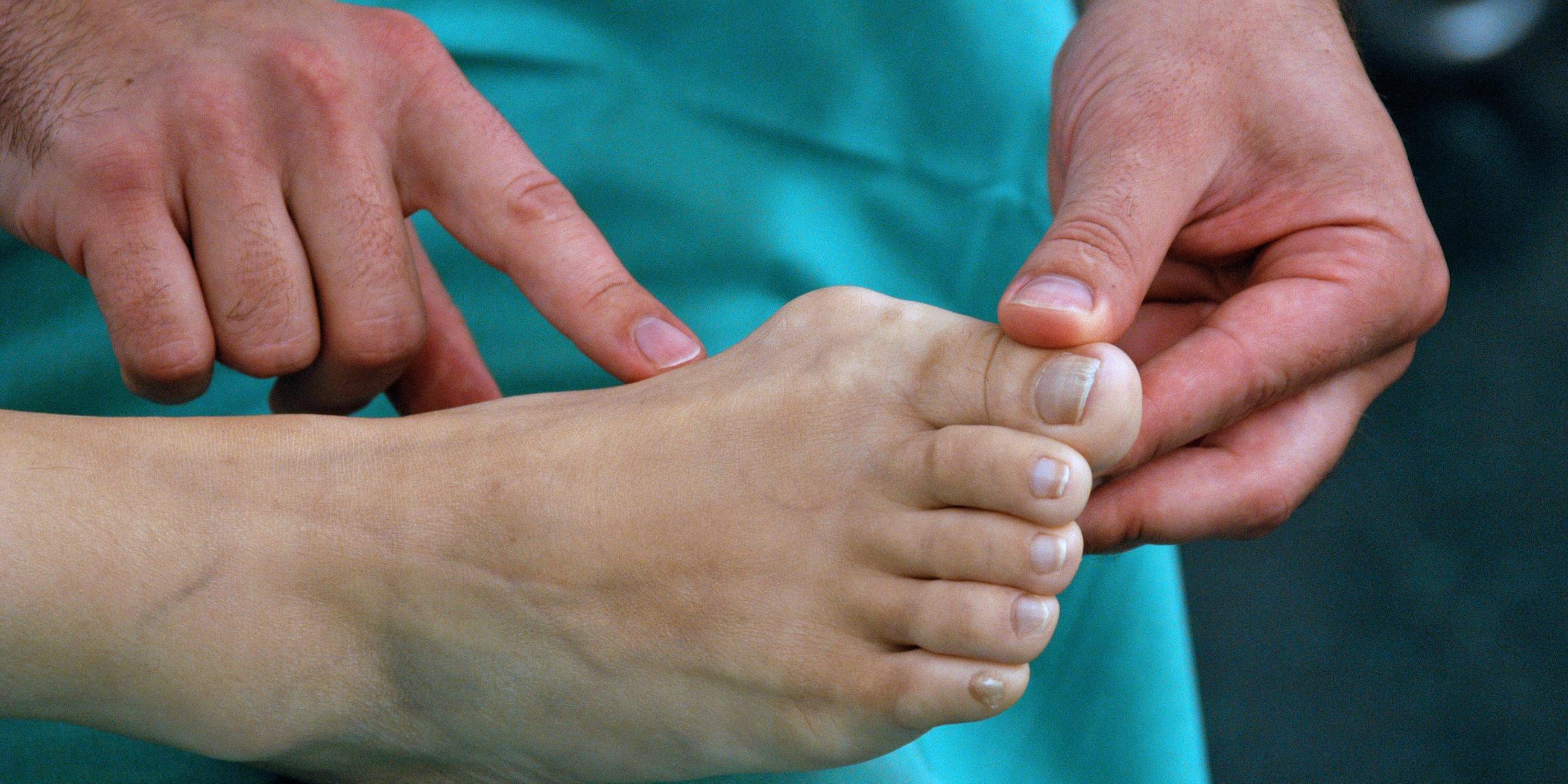 Ein Arzt in Nahaufnahme betrachtet den Hallux Valgus, einen Ballenzeh, an dem Fuß einer Frau.