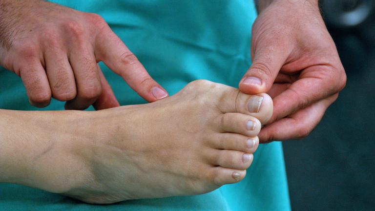 Ein Arzt in Nahaufnahme betrachtet den Hallux Valgus, einen Ballenzeh, an dem Fuß einer Frau.