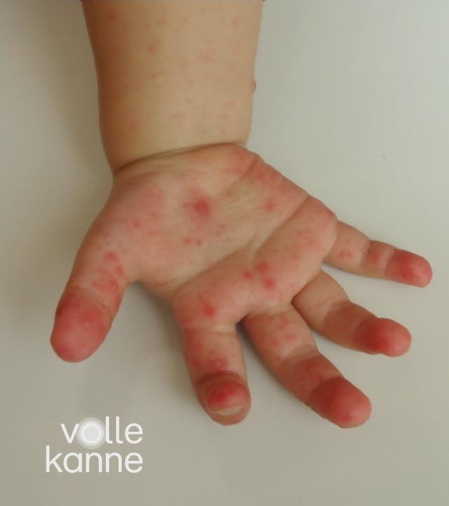 Hand-Mund-Fuß-Krankheit